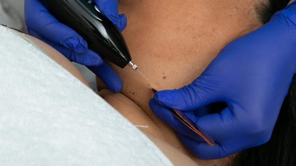 Skin tag removal – Momo’s beauty