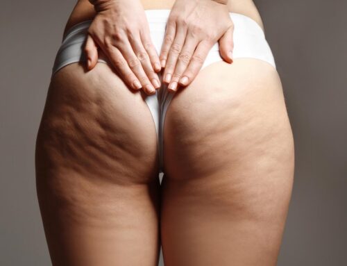 Facts about cellulite